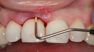 How to Get Rid of a Tooth Abscess Without Going to the Dentist [upl. by Nahsaj]