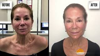 Kathie Lee Loves the Aerolase NeoSkin Rejuvenation Treatment [upl. by Nadda]