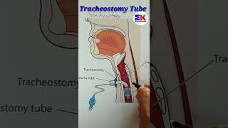 tracheostomy Tube shorts [upl. by Melgar]