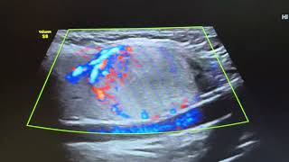 Ultrasound of hyperplastic adenomatous nodule in right lobe of thyroid [upl. by Htes]