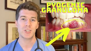 How to recognise and treat a Pyogenic Granuloma  Doctor ODonovan [upl. by Yhtrod495]