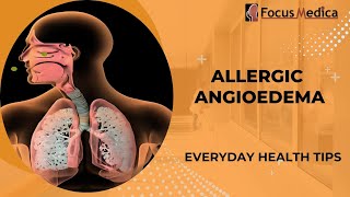 Allergic angioedemaSkin Allergy [upl. by Atrim]