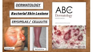 DERMATOLOGY Bacterial skin lesions  Erysipelas cellulitis derma erysiples cellulitis [upl. by Aribold]