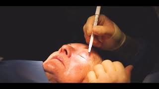 Blepharoplasty Procedure by Dr Reynolds [upl. by Naawaj]