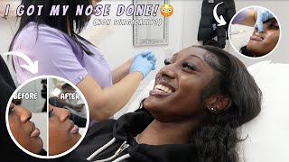 Guys I got a nose jobwith filler [upl. by Clarine15]