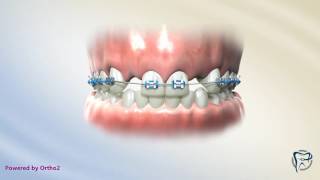 Missing Lateral Incisors Teeth in Retainer [upl. by Medeah]