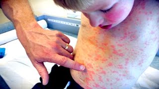 IMPRESSIVE FULL BODY RASH  Live Diagnosis With Dr Paul [upl. by Allis551]