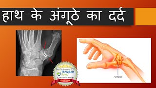 CMC arthritis Hindi [upl. by Lail33]