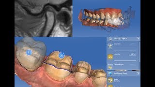 TMD Treated Via MRI ScanBased Mandibular Repositioning [upl. by Fadas298]