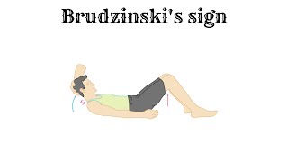 Brudzinskis sign [upl. by Ki]