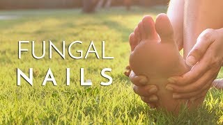 Principal Podiatrist Michael Lai Explains What Causes Fungal Toenails [upl. by Fulbert]