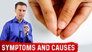 Iron Deficiency Symptoms and Causes of Anemia – DrBerg [upl. by Adiazteb]