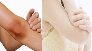 काली कोहनी और घुटनों को गोरा बनाने के उपाय Get Whitening Black Elbows And Knees 100 Working [upl. by Jeu]