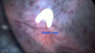 abdominal cyst [upl. by Stranger444]