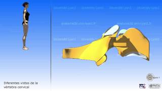 c5c6c7 Anterior Cervical Discectomy with Fusion [upl. by Cecilio]