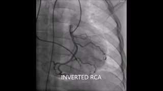 Inverted coronary arteries of corrected transposition of great arteries [upl. by Orecul]