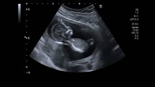 Beautiful Ultrasound Video of 14 Weeks Pregnancy Baby Girl [upl. by Alram399]