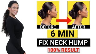 How to Fix a Neck Hump at Home FAST Fix Neck Hump FAST With These Home Exercises GymNought [upl. by Roosnam780]