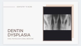 DENTIN DYSPLASIA [upl. by Meesaw]