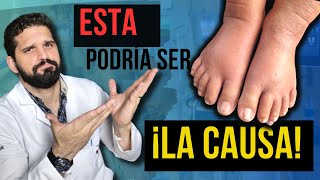 ¡MIRA ¿Por qué tus PIERNAS se HINCHAN ¡Descubre las posibles causas y SOLUCIONES✅ [upl. by Leonhard]