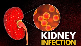 Kidney Infection Causes Signs and Symptoms Diagnosis and Treatment [upl. by Latia863]