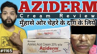 Aziderm 20 Cream Review  Cream For Melasma amp Acne [upl. by Yuh]