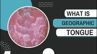 What is Geographic Tongue Causes Symptoms and Management [upl. by Niryt]