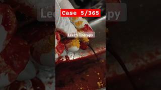 Case 5365  Leech Therapy  Skin Disorder bams leechtherapy leech [upl. by Sukul]