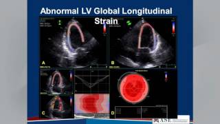 Echocardiographic Assessment of LV Diastolic Function Webinar [upl. by Reede]