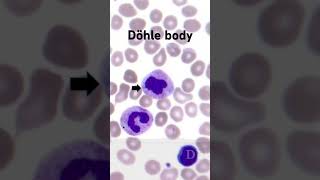 Döhle bodies on peripheral blood smear hemepath hematology pathology [upl. by Ttirrej]