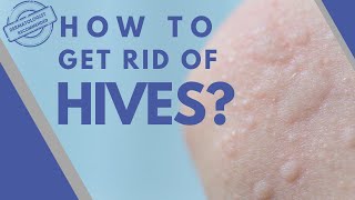 Dermatologists 1 Tip to Banish Hives Forever [upl. by Linnea]