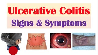 Ulcerative Colitis Signs and Symptoms amp Why They Occur and Complications [upl. by Ahsyat]