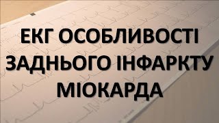 ІНФАРКТ МІОКАРДА ЗАДНЬОЇ СТІНКИ ЕКГ  ОСОБЛИВОСТІ [upl. by Araeit]