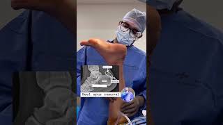 Heel spur removal fortishospitalmohali4685 orthopedics doctor sportsinjury [upl. by Kimberli]