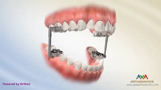 Orthodontic Treatment for Overjet Overbite  AdvanceSync Appliance [upl. by Aliuqa]