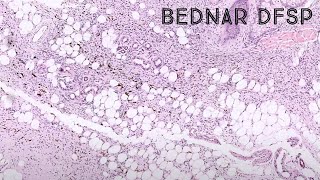 Bednar tumor dermatofibrosarcoma protuberans DFSP with melanin pigment pathology dermatology [upl. by Nymzaj]