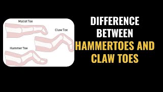 Hammer Toes vs Claw Toes vs MALLET TOES  Quick INFO [upl. by Fabria726]