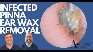 INFECTED PINNA EAR WAX REMOVAL  EP880 [upl. by Enillebyam191]