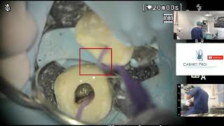 ENDO LIVE  Retraitement endodontique  Gestion dun lentulo fracturé [upl. by Clinton678]