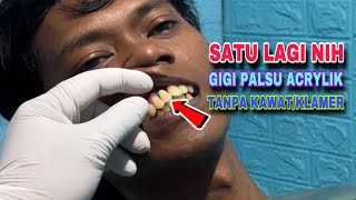 Ompongnya sudah lama tertarik pasang gigi liat video di youtube [upl. by Katrine]