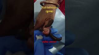 Nail infectionकुनख treatment by leech therapy [upl. by Amandie]