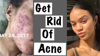 HOW I CLEARED MY ACNE  HORMONAL ACNE  CYSTIC ACNE [upl. by Richelle]