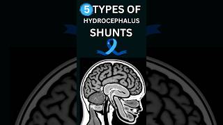 🧠 types of HYDROCEPHALUS shunts [upl. by Maureene]