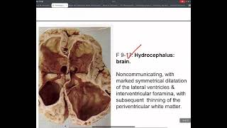 Pathology CNS cerebral edema HERNIATION amp HYDROCEPHALUS L1 part 2 [upl. by Nagaem]