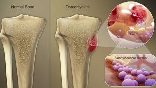 OSTEOMIELITIS [upl. by Nodab677]