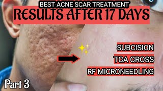 PART 3  RESULTS BEFORE AND AFTER ACNE SCAR TREATMENT [upl. by Asir]