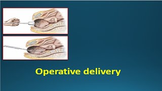 OPERATIVE DELIVERY  Instrumental deliveries Vacuum amp Forceps [upl. by Enoyrt906]