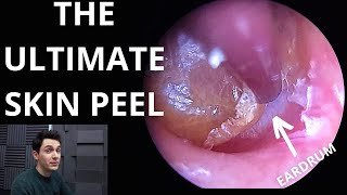 The Ultimate Skin Peel Dead Skin Lifted From Trapped Eardrum [upl. by Nowahs216]