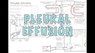 Pleural Effusion DETAILED  pathophysiology signs and symptoms treatment [upl. by Toiboid725]