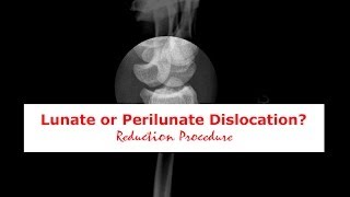 Lunate or Perilunate Dislocation [upl. by Neoma]